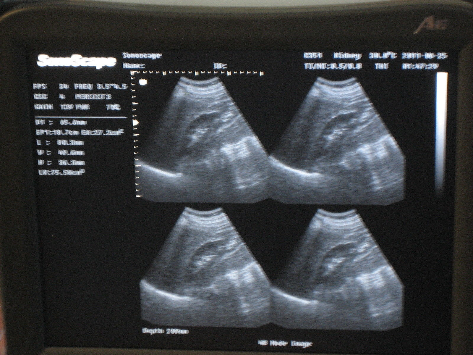 Ultrasound SonoScape A6 B/W with Convexo and Endovaginal DIAGNOSTIC ULTRASOUND MACHINES FOR SALE