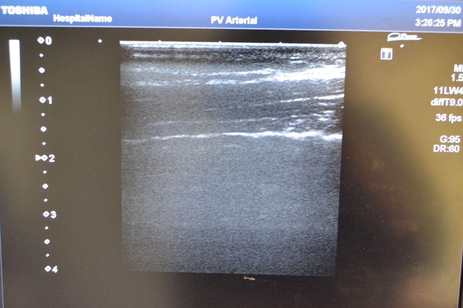 Toshiba Artida PLT-704SBT 11-4.8MHz Linear Ultrasound Transducer Probe J1625 DIAGNOSTIC ULTRASOUND MACHINES FOR SALE