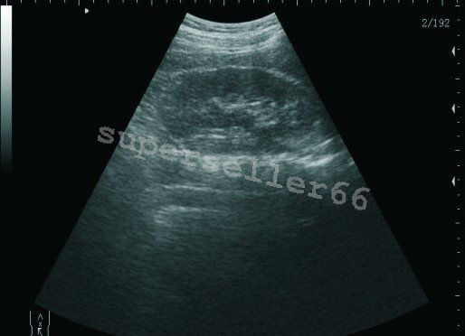 Portable Laptop Digital Ultrasound scanner,multi-frequency Transvaginal Probe DIAGNOSTIC ULTRASOUND MACHINES FOR SALE