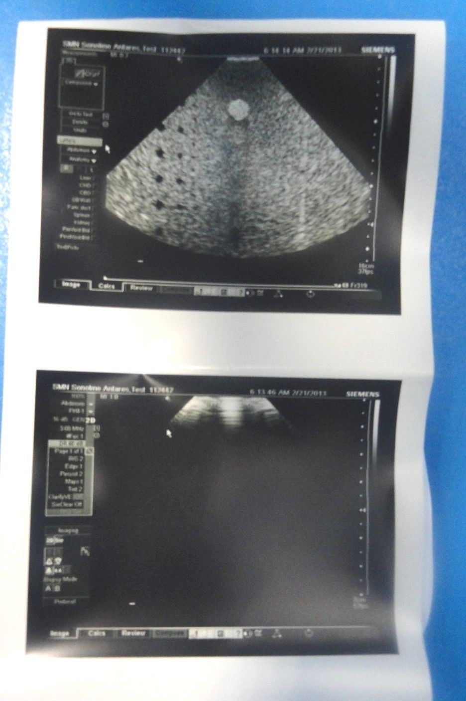2008 Siemens Acuson Antares PH4-1 Frequency 4–1 MHz Ultrasound Probe (6831) DIAGNOSTIC ULTRASOUND MACHINES FOR SALE