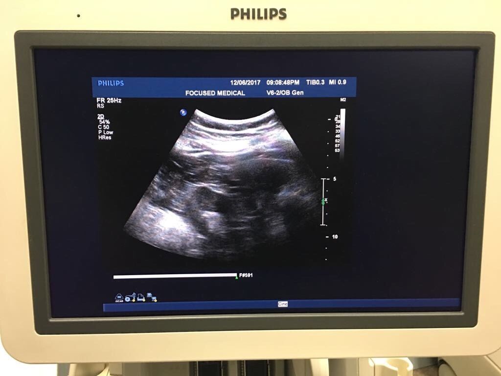 Philips V6-2 Ultrasound Transducer Probe DIAGNOSTIC ULTRASOUND MACHINES FOR SALE