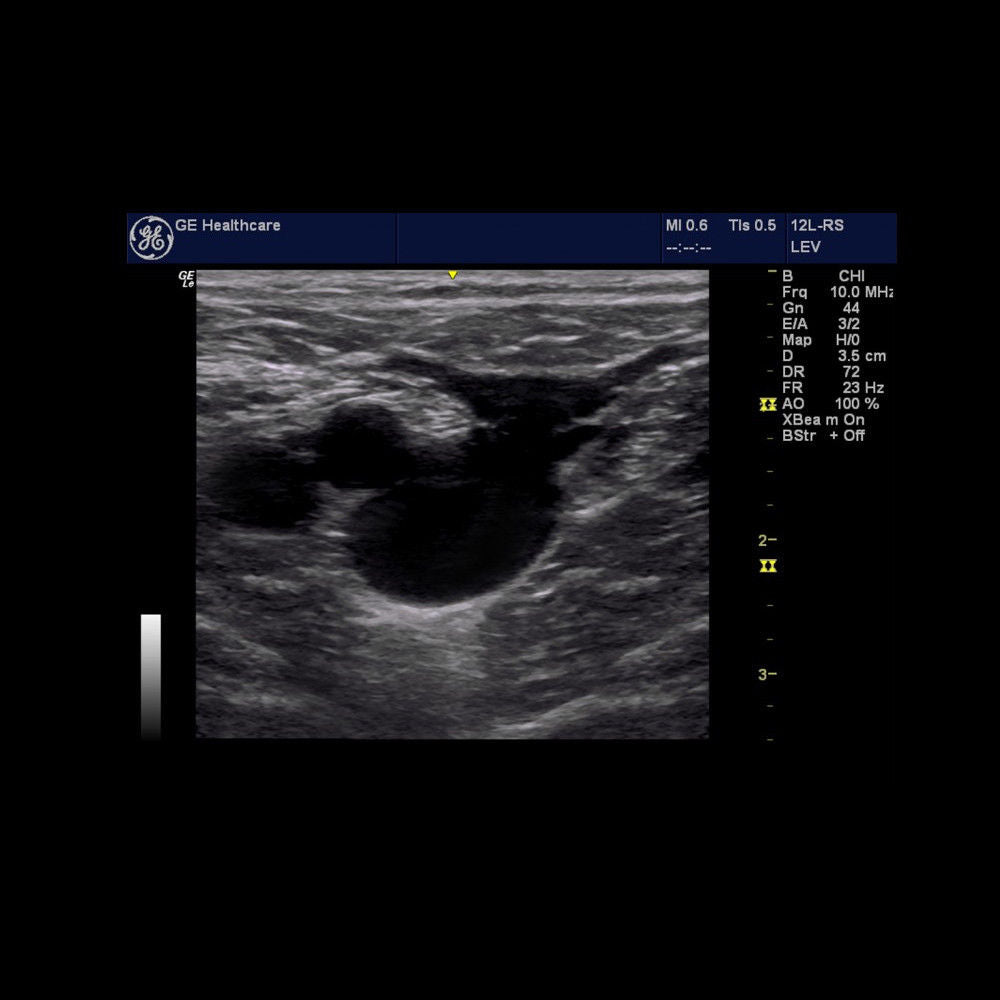 GE LOGIQ E Portable Ultrasound System Machine with 12L-RS Linear Probe DIAGNOSTIC ULTRASOUND MACHINES FOR SALE