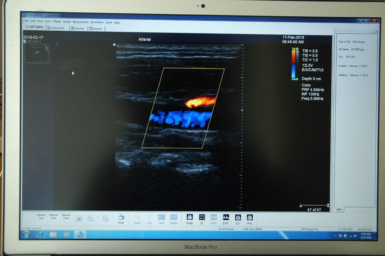 Macbook Pro Terason T3000 with linear 7L3 or 12L5 Transducer, like Siemens P50 DIAGNOSTIC ULTRASOUND MACHINES FOR SALE