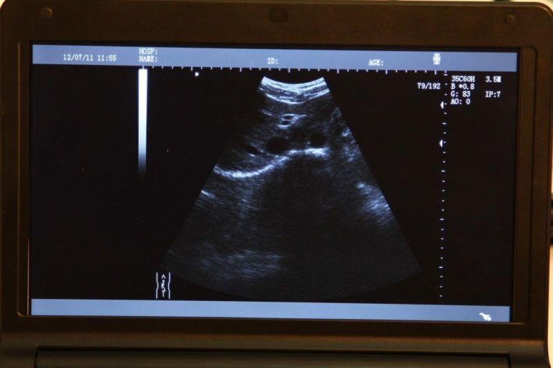 Top Laptop Ultrasound Machine Ultrasound Scanner 6.5 MHZ Transvaginal Probe + 3D DIAGNOSTIC ULTRASOUND MACHINES FOR SALE