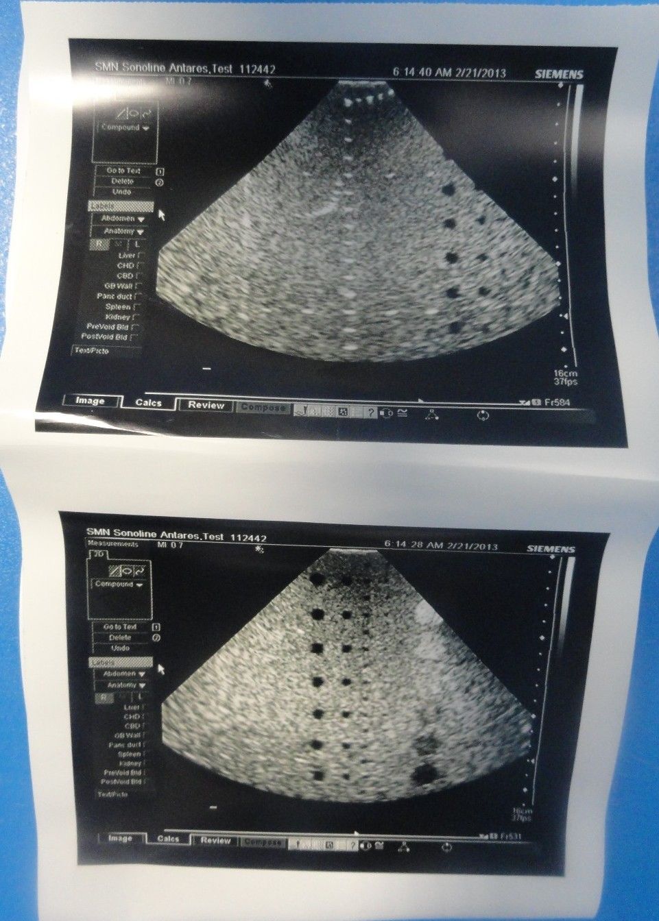 2008 Siemens Acuson Antares PH4-1 Frequency 4–1 MHz Ultrasound Probe (6831) DIAGNOSTIC ULTRASOUND MACHINES FOR SALE
