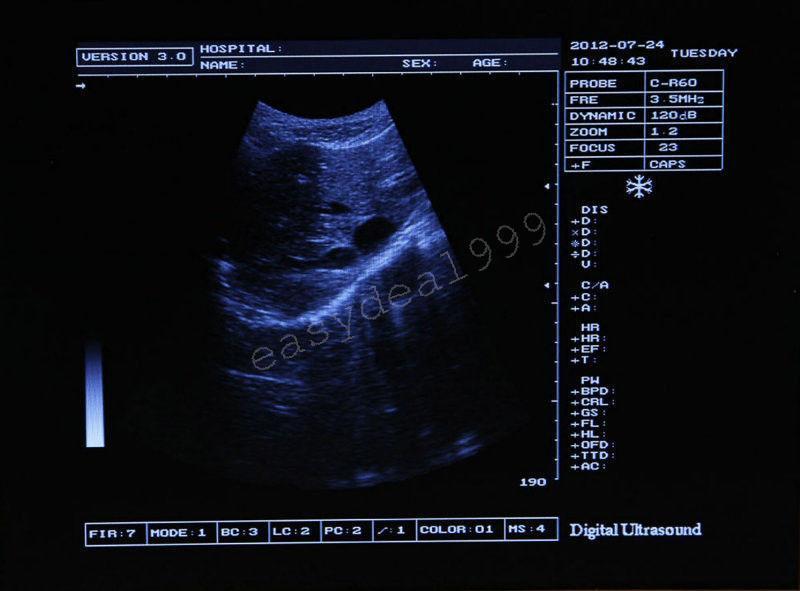 Digital Portable Ultrasound Scanner Machine Convex Linear Transvaginal 3 Probes* DIAGNOSTIC ULTRASOUND MACHINES FOR SALE