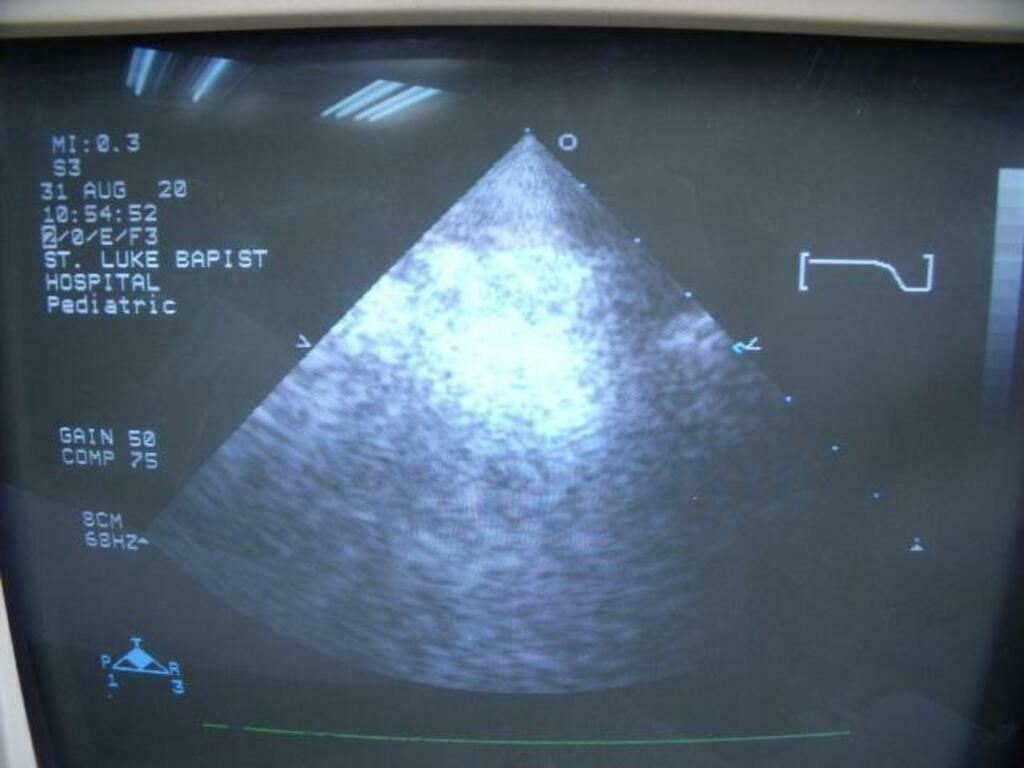 Philips 21311A S3 Ultrasound Probe | PR5323 DIAGNOSTIC ULTRASOUND MACHINES FOR SALE