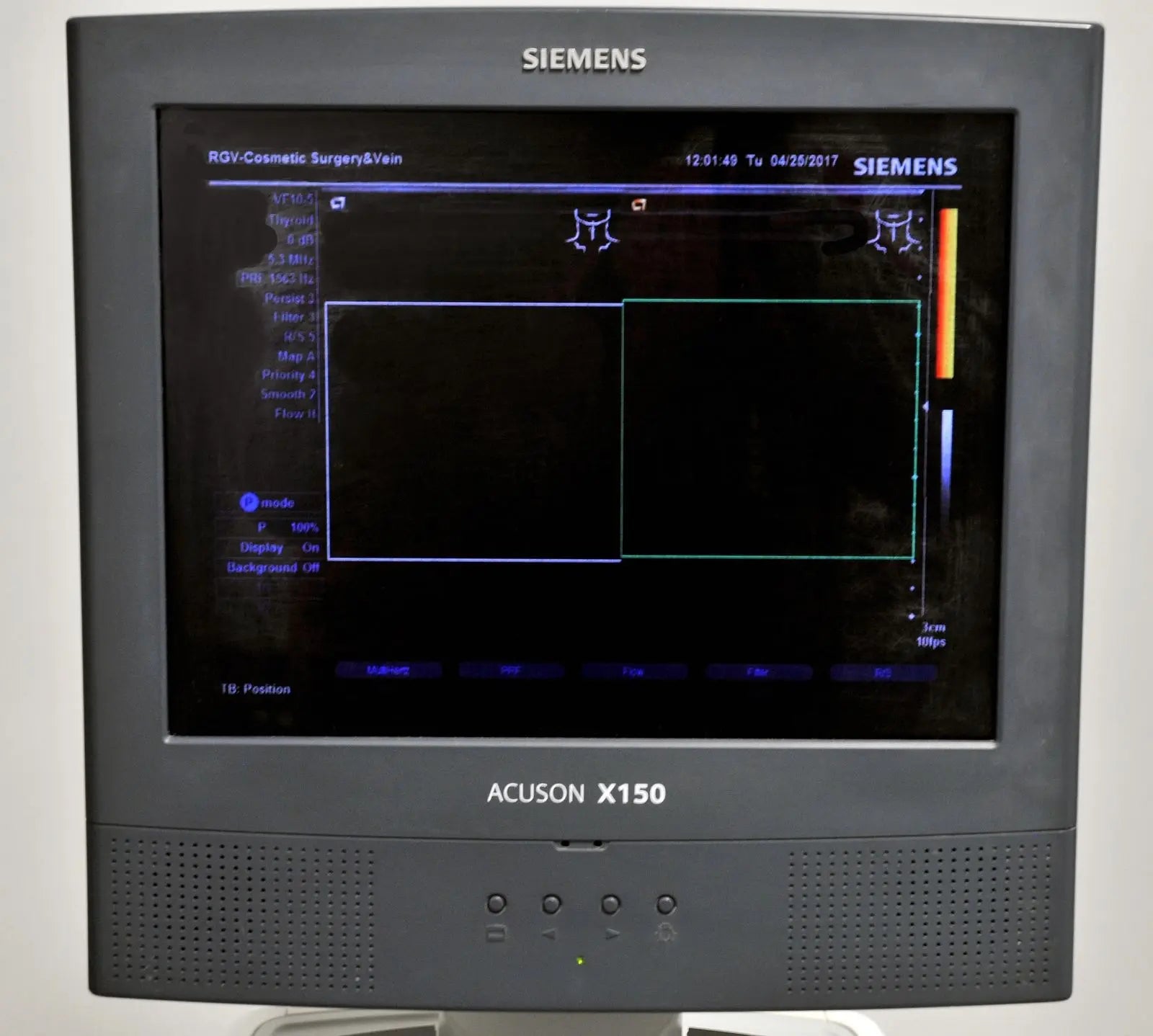 Siemens Acuson X150 Ultrasound Sonogram Pulsed Wave Doppler Imaging System X 150 DIAGNOSTIC ULTRASOUND MACHINES FOR SALE