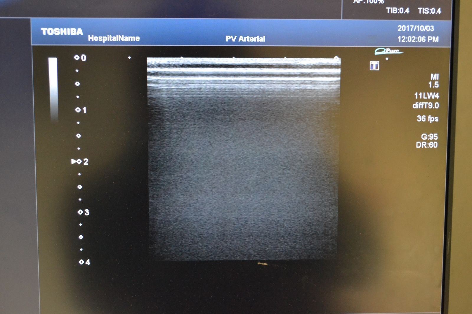 Toshiba Artida PLT-704SBT 11-4.8MHz Linear Ultrasound Transducer Probe  J1629 DIAGNOSTIC ULTRASOUND MACHINES FOR SALE