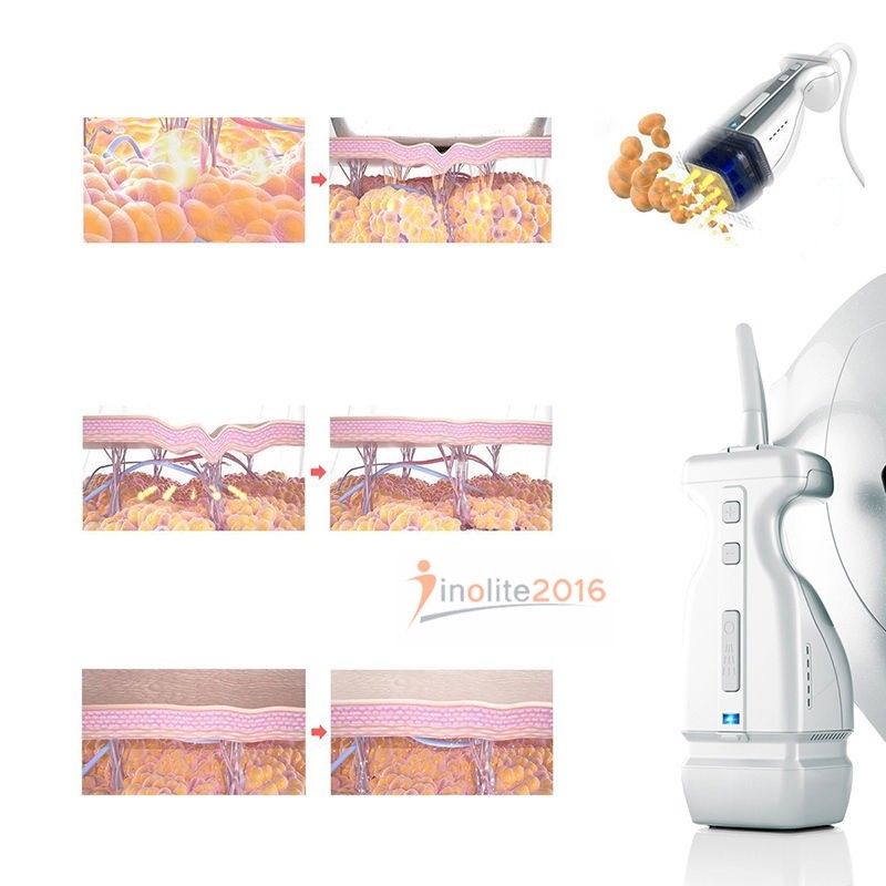 HIFU High Intensity Focused Ultrasound Ultrasonic RF Slimi Machine Skin Firming DIAGNOSTIC ULTRASOUND MACHINES FOR SALE