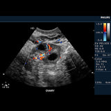 CVO Philips HD11-XE - Fully Equipped Ultrasound Machine ECG Stress Echo Cardiac