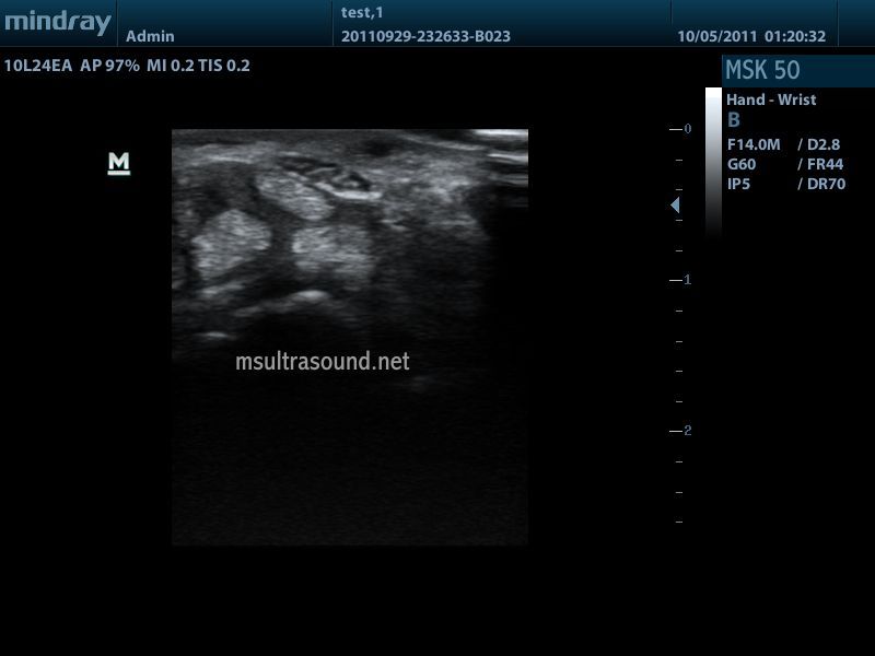 Mindray DP-50 Ultrasound with Linear Transducer DIAGNOSTIC ULTRASOUND MACHINES FOR SALE