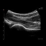 Wireless Siemens Acuson Freestyle - Portable Ultrasound System Handheld Machine