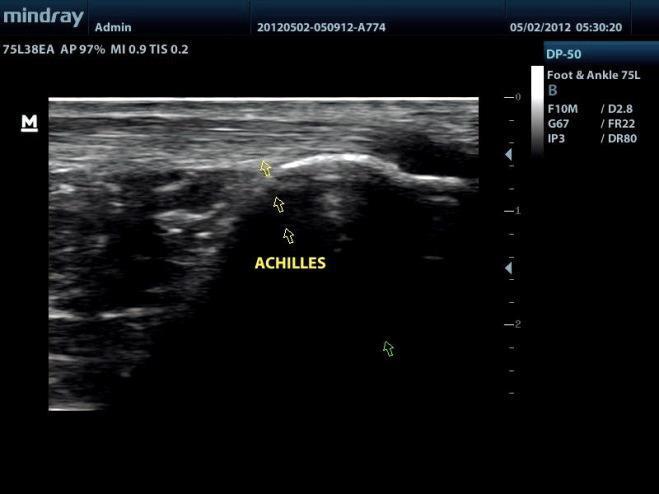 Mindray DP-50 Ultrasound with Linear Transducer DIAGNOSTIC ULTRASOUND MACHINES FOR SALE