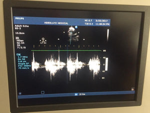 Philips HD15 Cardiac Ultrasound Echocardiogram machine and S5-2 Transducer Probe