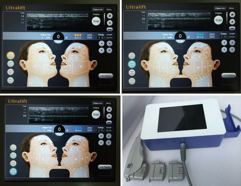 High Intensity Focused Ultrasound HIFU Ultrasonic RF Facial Anti Wrinkle Machine 601393982494 DIAGNOSTIC ULTRASOUND MACHINES FOR SALE