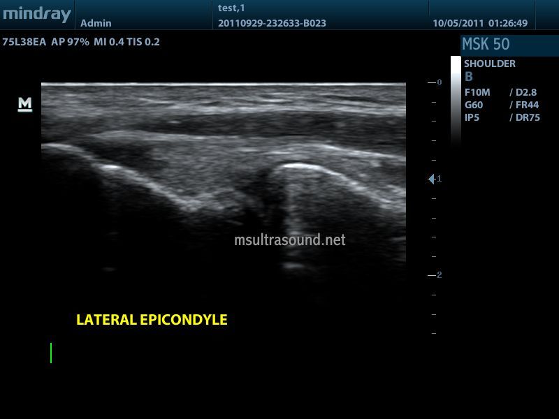 Mindray DP-50 Ultrasound with Linear Transducer DIAGNOSTIC ULTRASOUND MACHINES FOR SALE