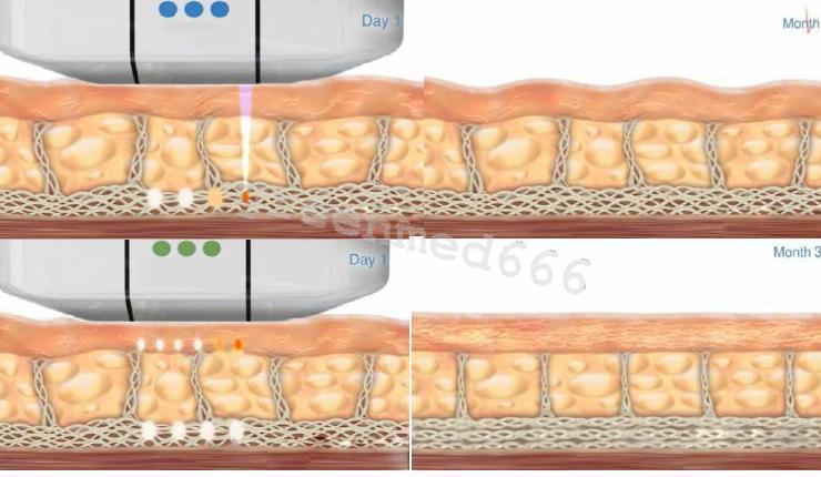 Facial Lifting Skin Tighten Anti-Wrinkle HIFU High Intensity Focused Ultrasound DIAGNOSTIC ULTRASOUND MACHINES FOR SALE