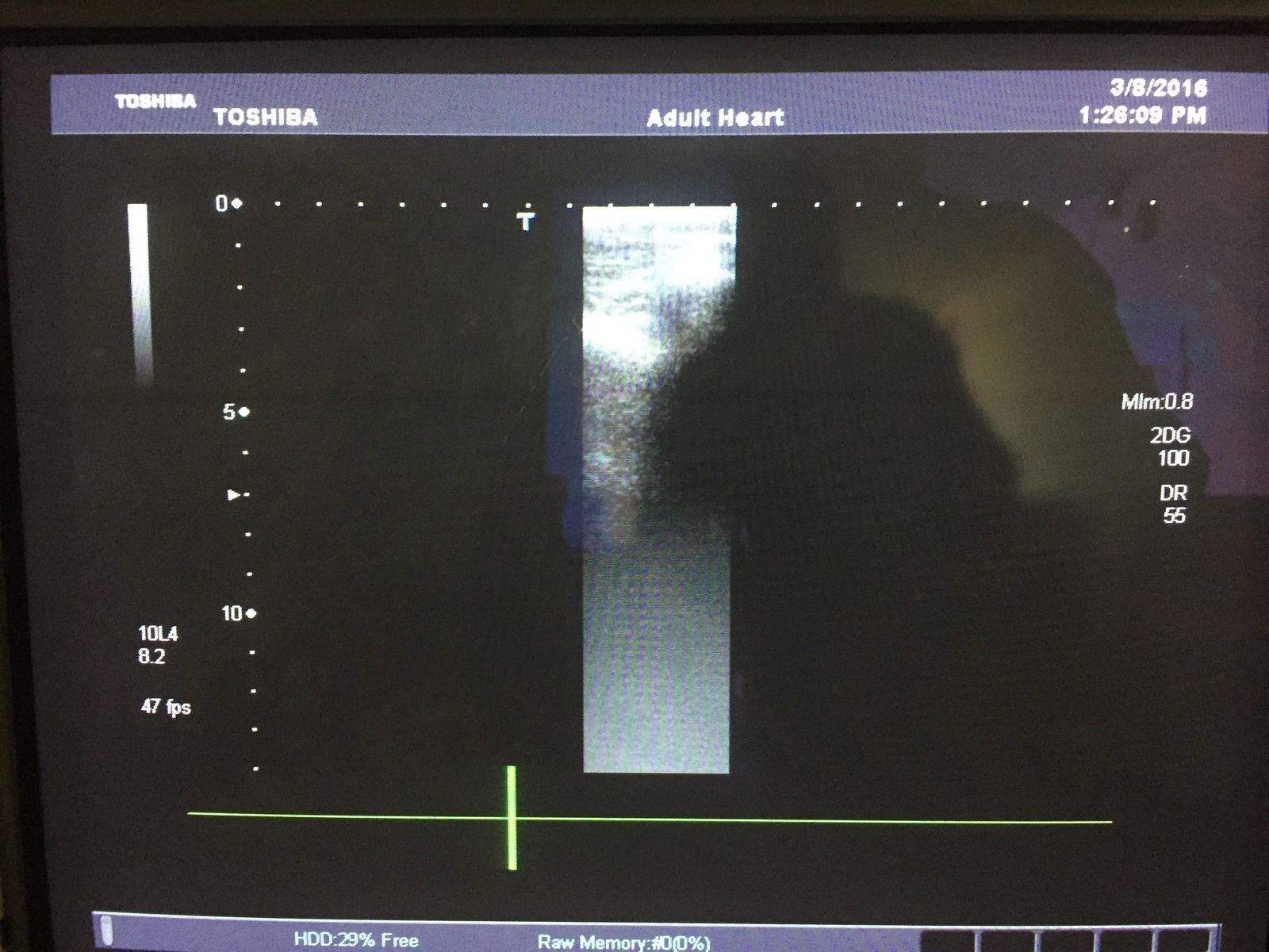 Toshiba Aplio XG PLT-604AT 6MHz Linear Ultrasound Transducer DIAGNOSTIC ULTRASOUND MACHINES FOR SALE