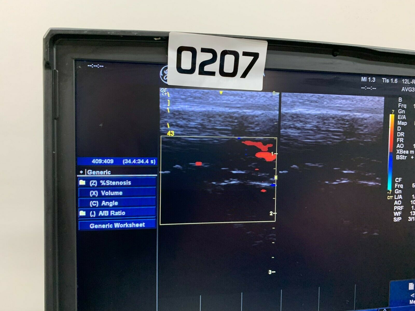 GE Logiq e NextGen Portable Ultrasound 5419804 W/12L-RS Probe V R7.0.3 0207 DIAGNOSTIC ULTRASOUND MACHINES FOR SALE