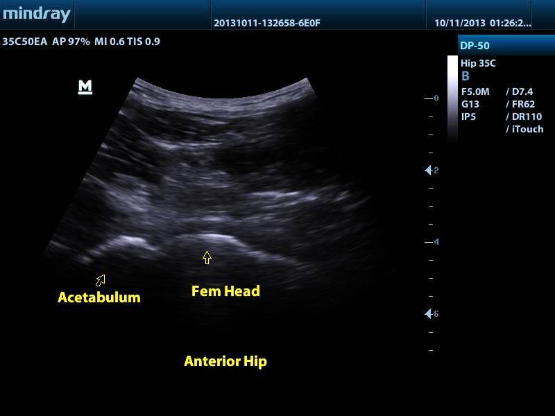 Mindray DP-50 Ultrasound with Linear Transducer DIAGNOSTIC ULTRASOUND MACHINES FOR SALE