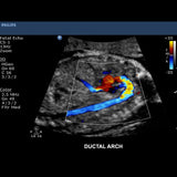 Philips CX50 Portable Ultrasound System with S5-1 Cardiac Sector Transducer
