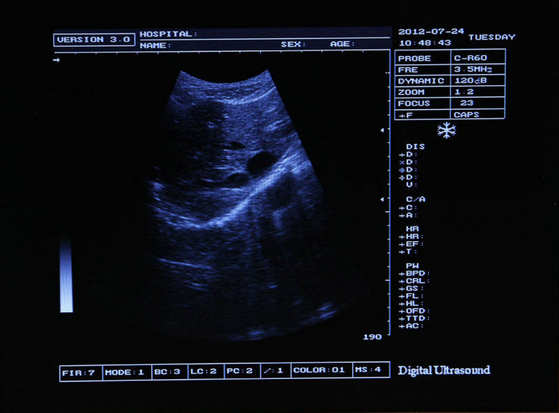 Full Digital Laptop Portable Ultrasound Scanner+Transvaginal Probe  external 3D DIAGNOSTIC ULTRASOUND MACHINES FOR SALE