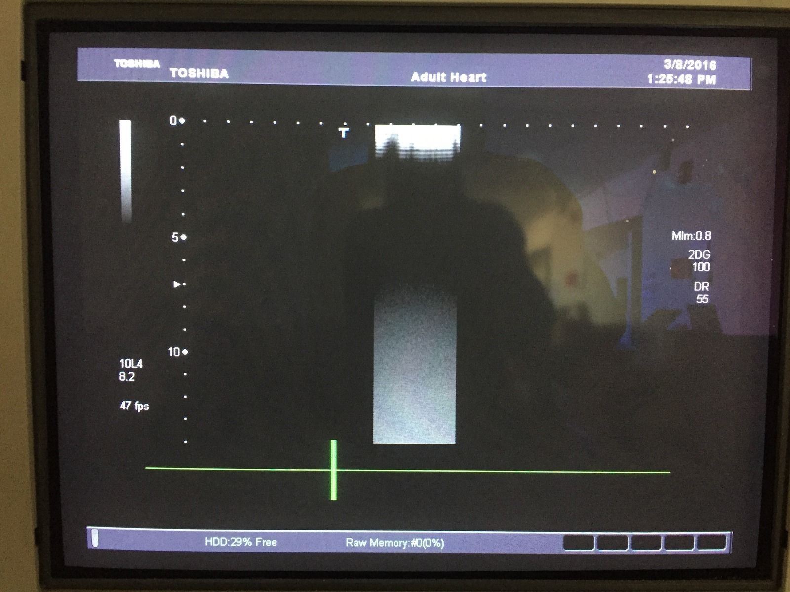 Toshiba Aplio XG PLT-604AT 6MHz Linear Ultrasound Transducer DIAGNOSTIC ULTRASOUND MACHINES FOR SALE